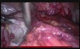 Total Laparoscopic Hysterectomy Stage 4 Endometriosis
