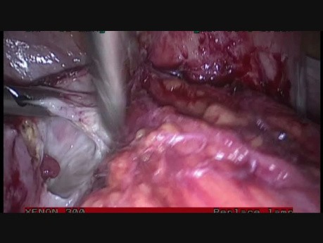 Total Laparoscopic Hysterectomy Stage 4 Endometriosis