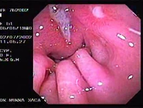 Gastric Ulcers and Myasthenia Gravis