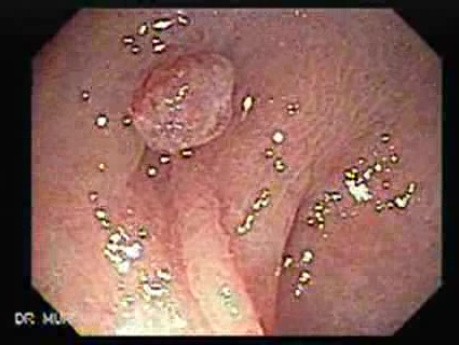 Polyp Inside Of A Diverticulum (2 of 12)