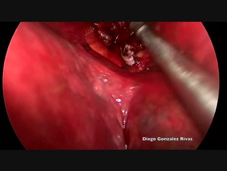 Non Intubated Uniportal VATS Right Upper Posterior