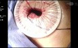 Pleuroscopy & Biopsy