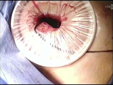 Pleuroscopy & Biopsy
