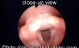 Rima Glottis After Transoral CO2-Laser Cordectomy Type III-The Laryngeal View