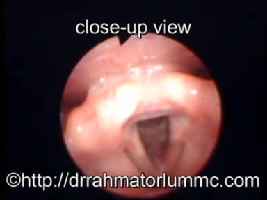 Rima Glottis After Transoral CO2-Laser Cordectomy Type III-The Laryngeal View