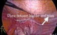 Post Hysterectomy Broad Ligament Fibroid Removal
