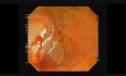 Two cecum polyps, polypectomy