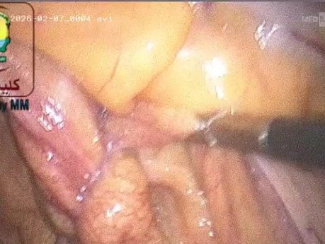 Struggling to Retrieve a Missed IUD