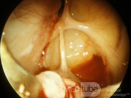 Maxillary Sinus Cyst [sinoscopy]