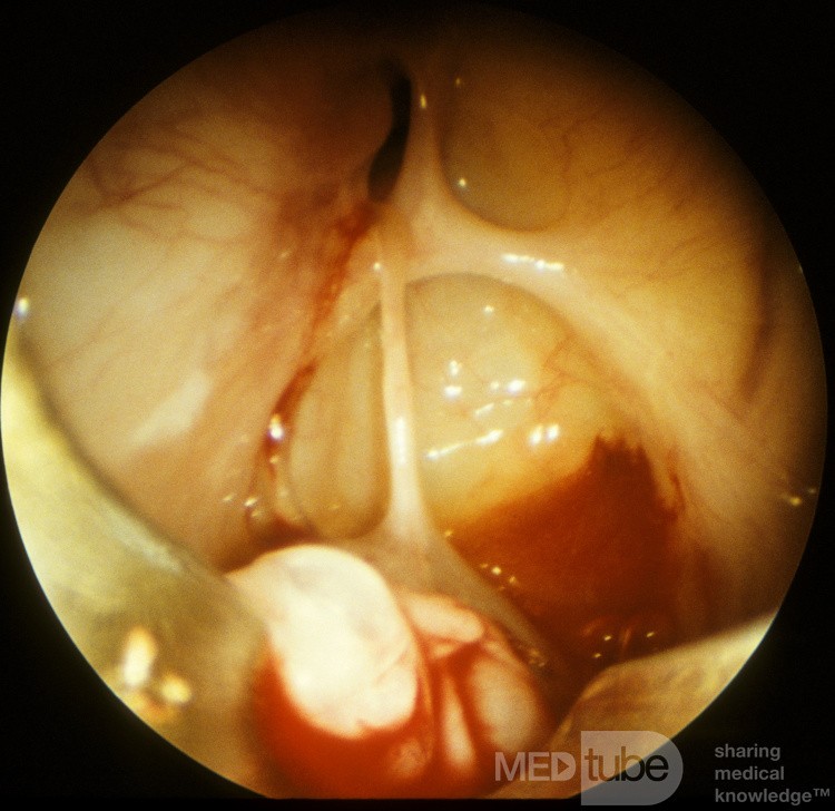 Maxillary Sinus Cyst [sinoscopy]