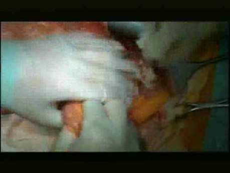 Open Right Hemicolectomy – Technical Principles - Operation No 1 - Part 2
