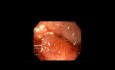 Over the Scope Clip for Sleeve Gastrectomy Fistula Closure
