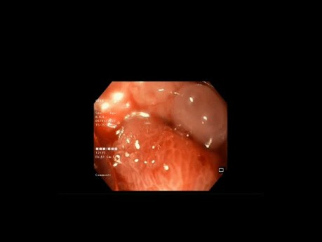 Over the Scope Clip for Sleeve Gastrectomy Fistula Closure