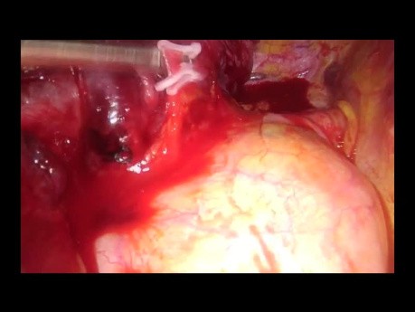 Uniportal VATS Right Upper Anterior Segmentectomy (S3)