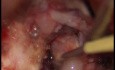 Tentorial Chordoid Meningioma - Modified Left Subtemporal Approach