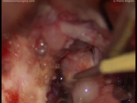 Tentorial Chordoid Meningioma - Modified Left Subtemporal Approach
