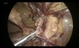 Laparoscopic Femoral Hernia Anatomy Explained TAPP 