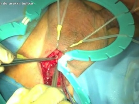 Artificial Sphincter Surgery in Male Incontinence