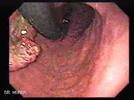 Adenocarcinoma of the Corpus (3 of 6)