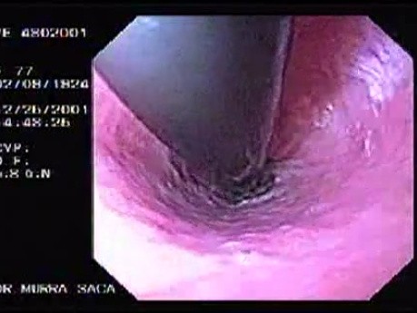 Hemorrhage due status post rubber band ligation of esophageal varices (4 of 25)