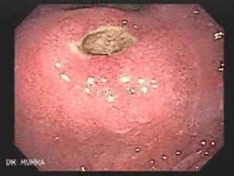 Gastric Ulcer - Endoscopy (1 of 3)