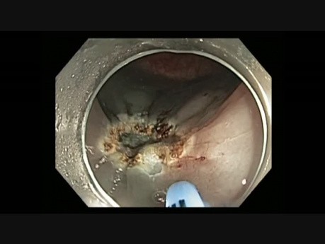 Colonoscopy - Sigmoid Colon - LST-G tumor - EMR