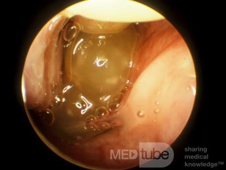 Massive Nasal Polyps Pre-Prednisone