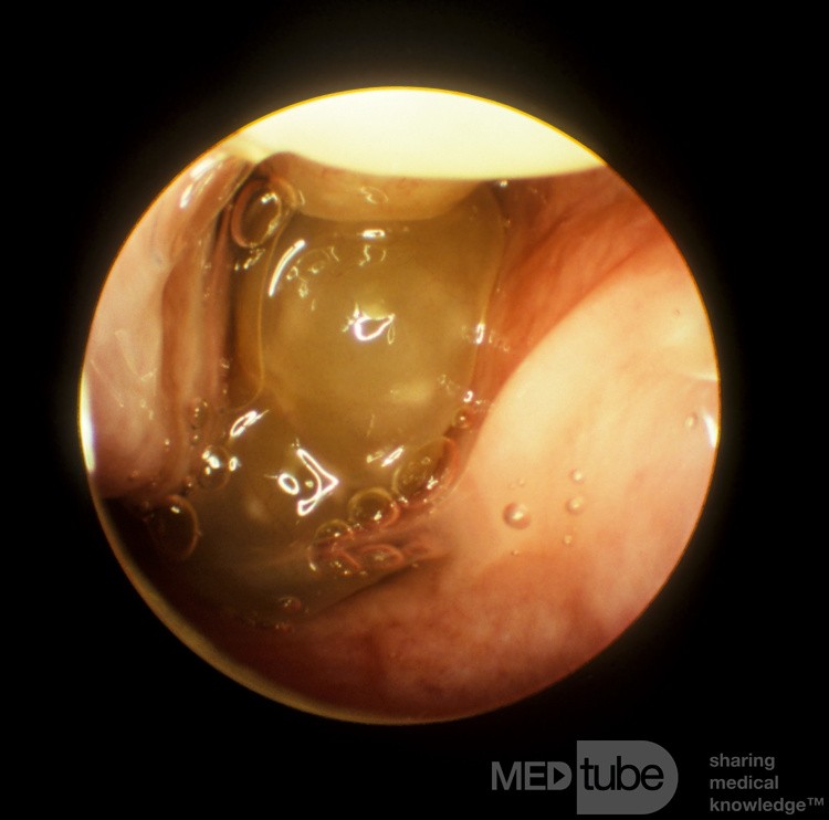 Massive Nasal Polyps Pre-Prednisone