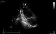 Simpson's Biplane Method for Accurate Assessment of Left Ventricular Ejection Fraction