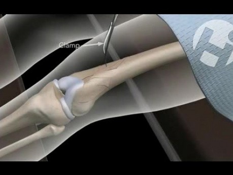 Open Reduction Internal Fixation of Femur Fracture