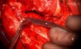 Right Middle Fossa Approach for Resection of Meckel's Cave Meningioma with Extension to Post. Fossa