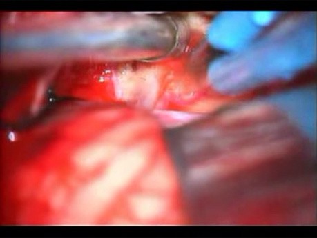 Acoustic Schwannoma
