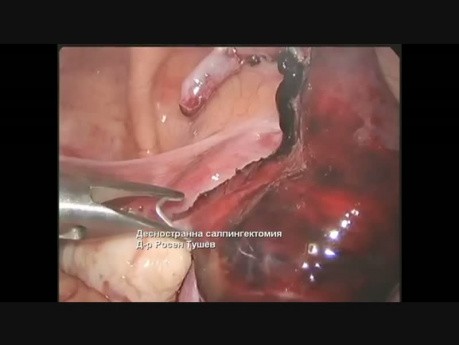 Еctopic Pregnancy