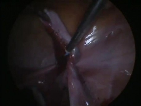 Misdiagnosis of a Right Broad Ligamentary Cyst Managed by Laparoscopy