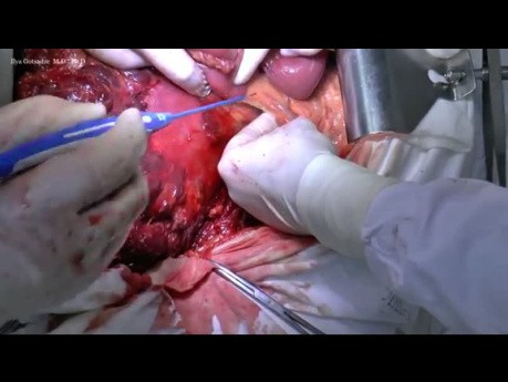 Retroperitoneal Pseudotumor - Posttraumatic Giant Hematoma