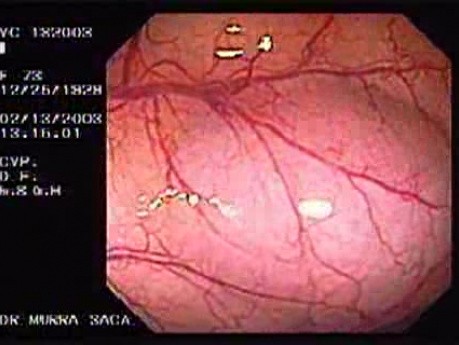 Splenic Flexure (1 of 2)