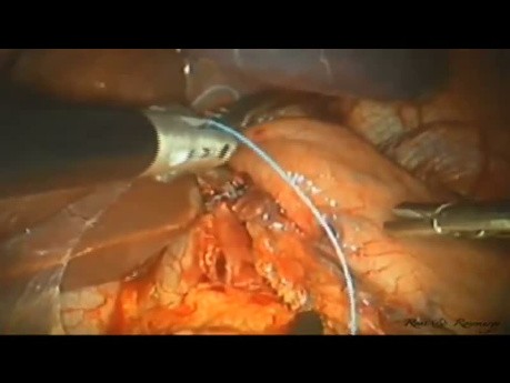 Conventional Laparoscopy to Laparo-Endoscopic Single Site (LESS) Heller Myotomy For Achalasia