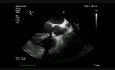 Infective Endocarditis BAV