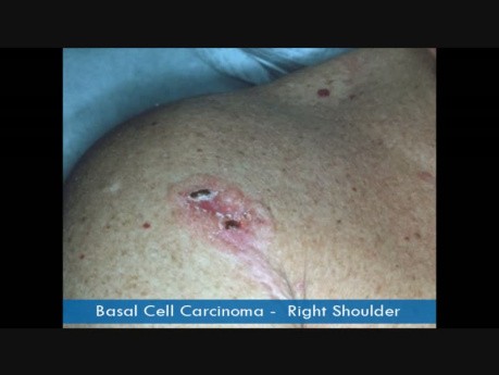 Types of Skin Cancers