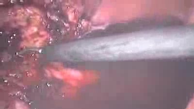 Laparoscopic Supracervical (Subtotal) Hysterectomy - LASH