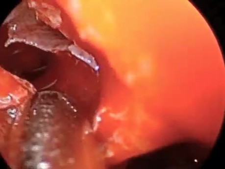 Endoscopic Sinus Surgery - Removal of Sphenoid Polyps