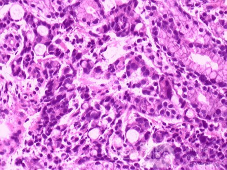 Diffuse Adenocarcinoma with signet ring cells (15 of 18)
