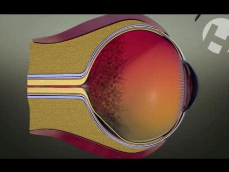 Vitrectomy, Membrane Peeling And Scleral Buckle