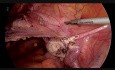 TLH with Ureter Stenting