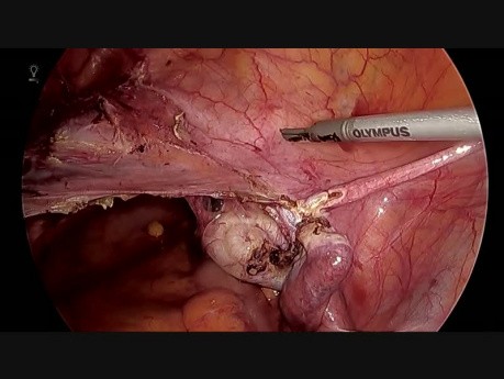 TLH with Ureter Stenting
