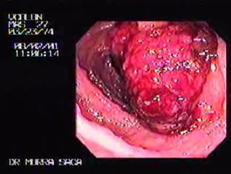 Familial Adenomatous Polyposis of the Colon (1 of 29)