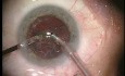 Cataract phacoemulsification