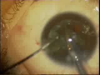 Phacoemulsification - Horizontal Chopping