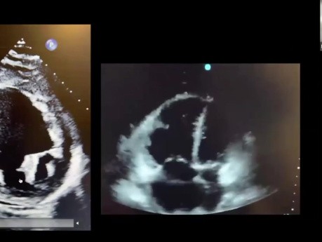 Hocus Pocus: Using POCUS for Volume & Hemodynamics Assessment and Quick Peculiar Diagnoses