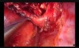 Uniportal Thoracoscopic Sleeve Lobectomy after Induction Therapy